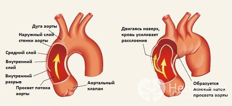 Расслаивающая аневризма аорты